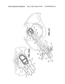 INSERTION DEVICE FOR USE DURING RETROPERITONEAL LATERAL INSERTION OF     SPINAL IMPLANTS diagram and image