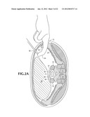 SPINAL IMPLANT FOR USE DURING RETROPERITONEAL LATERAL INSERTION PROCEDURES diagram and image