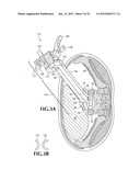 SPINAL IMPLANT FOR USE DURING RETROPERITONEAL LATERAL INSERTION PROCEDURES diagram and image