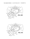 SPINAL IMPLANT FOR USE DURING RETROPERITONEAL LATERAL INSERTION PROCEDURES diagram and image