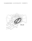 SPINAL IMPLANT FOR USE DURING RETROPERITONEAL LATERAL INSERTION PROCEDURES diagram and image