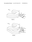 METHODS AND MATERIALS FOR ORAL STENTING diagram and image