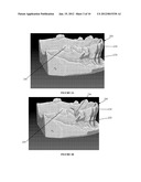 METHOD OF DESIGNING A DENTAL PROSTHETIC, AND COMPUTER READABLE MEDIUM FOR     PERFORMING A METHOD OF DESIGNING A DENTAL PROSTHETIC diagram and image