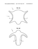 IMPLANT FOR TREATING A GENITAL PROLAPSE, AND ASSOCIATED TREATMENT METHOD diagram and image
