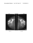 SKIN ADHESIVE AGENT FOR MAMMOGRAPHY PROCEDURES diagram and image