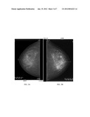 SKIN ADHESIVE AGENT FOR MAMMOGRAPHY PROCEDURES diagram and image