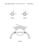 OCULAR IMPLANT WITH STIFFNESS QUALITIES, METHODS OF IMPLANTATION AND     SYSTEM diagram and image