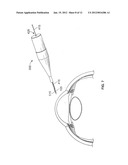 OCULAR IMPLANT WITH STIFFNESS QUALITIES, METHODS OF IMPLANTATION AND     SYSTEM diagram and image