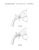 OCULAR IMPLANT WITH STIFFNESS QUALITIES, METHODS OF IMPLANTATION AND     SYSTEM diagram and image