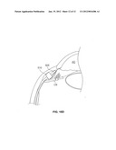 OCULAR IMPLANT WITH STIFFNESS QUALITIES, METHODS OF IMPLANTATION AND     SYSTEM diagram and image