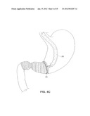 SATIATION DEVICES AND METHODS diagram and image