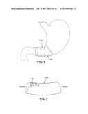 SATIATION DEVICES AND METHODS diagram and image