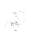 SATIATION DEVICES AND METHODS diagram and image