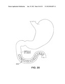 SATIATION DEVICES AND METHODS diagram and image