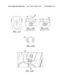 CATHETER STABILIZATION DEVICE diagram and image