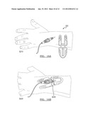 CATHETER STABILIZATION DEVICE diagram and image