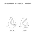 GUIDING CATHETER STABILIZATION SYSTEM diagram and image