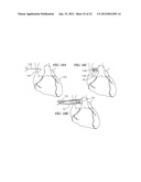 METHOD AND APPARATUS FOR CLOSING AN OPENING IN THICK, MOVING TISSUE diagram and image