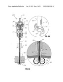 METHOD FOR SUTURING diagram and image