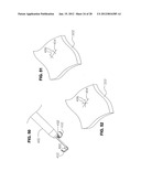 METHOD FOR SUTURING diagram and image