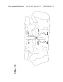 FLEXING LINKS FOR INTERVERTEBRAL STABILIZATION diagram and image