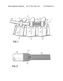 SPINAL STABILIZATION SYSTEM WITH RIGID AND FLEXIBLE ELEMENTS diagram and image