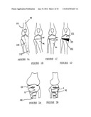 OSTEOSYNTHESIS DEVICE diagram and image