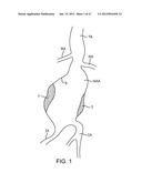 Stent Graft Delivery System diagram and image