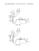 Stent Graft Delivery System diagram and image