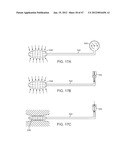 Stent Graft Delivery System diagram and image