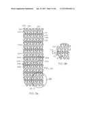 Stent diagram and image