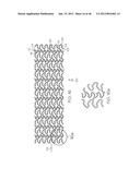 Stent diagram and image