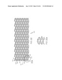 Stent diagram and image