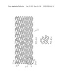 Stent diagram and image