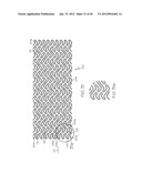 Stent diagram and image