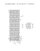 Stent diagram and image