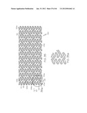 Stent diagram and image