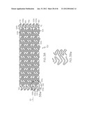 Stent diagram and image