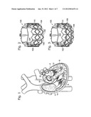 TRANSCATHETER HEART VALVE WITH MICRO-ANCHORS diagram and image