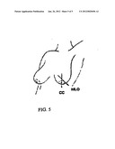 MAMMOGRAPHY SYSTEM AND METHOD EMPLOYING OFFSET COMPRESSION PADDLES     AUTOMATIC COLLIMATION AND RETRACTABLE ANTI-SCATTER GRID diagram and image