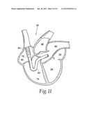 Method and Apparatus for Preventing Air Embolisms diagram and image