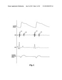 PULSE DETECTION APPARATUS, SOFTWARE, AND METHODS USING PATIENT     PHYSIOLOGICAL SIGNALS diagram and image