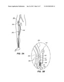 BYPASS VASCULAR GRAFT diagram and image