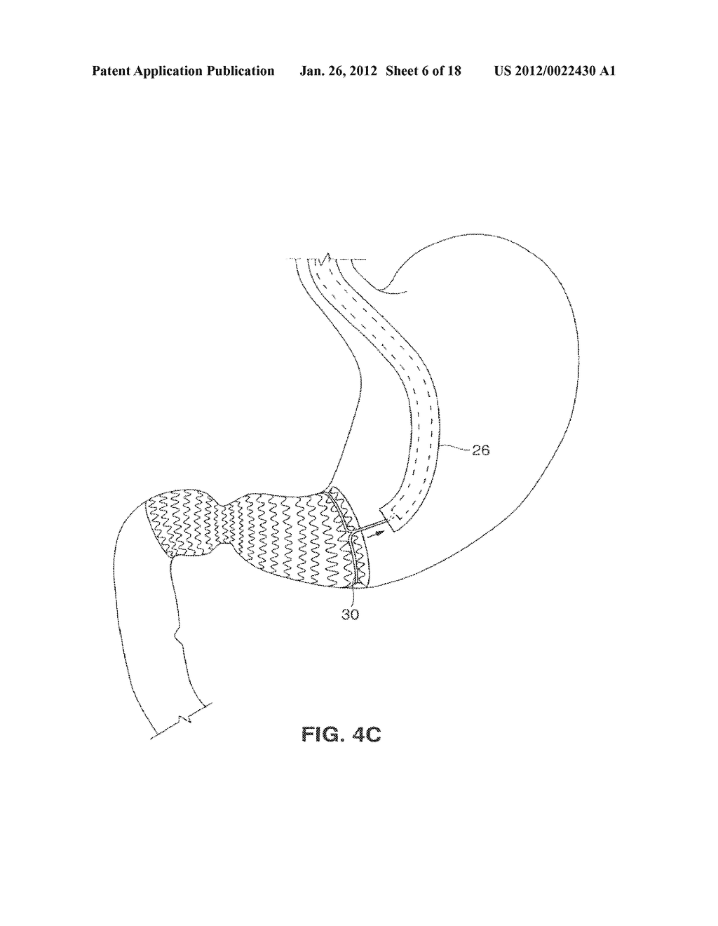 SATIATION DEVICES AND METHODS - diagram, schematic, and image 07