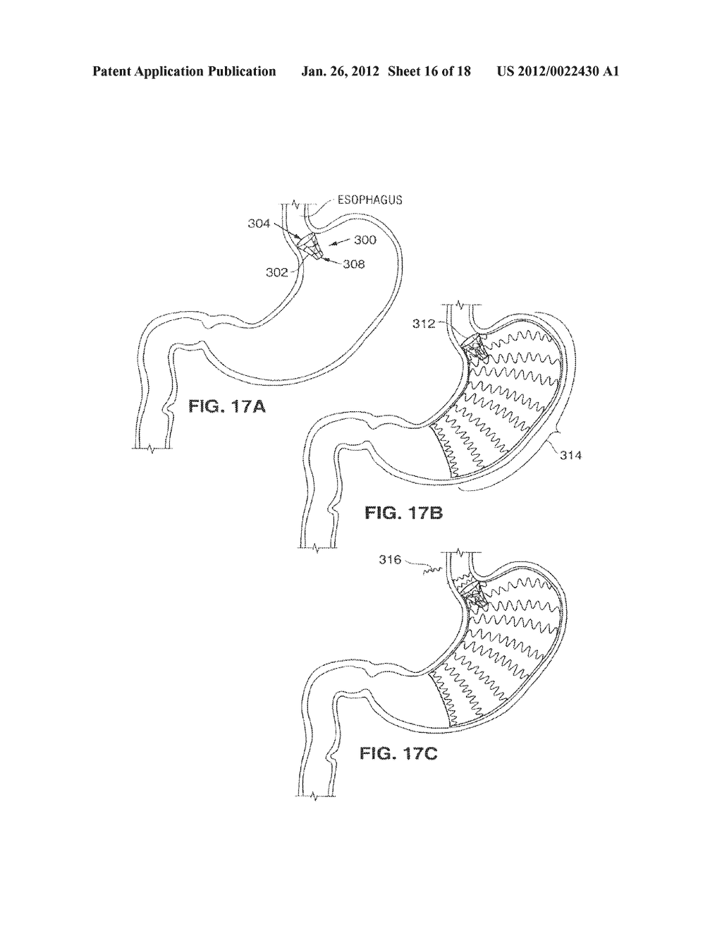 SATIATION DEVICES AND METHODS - diagram, schematic, and image 17