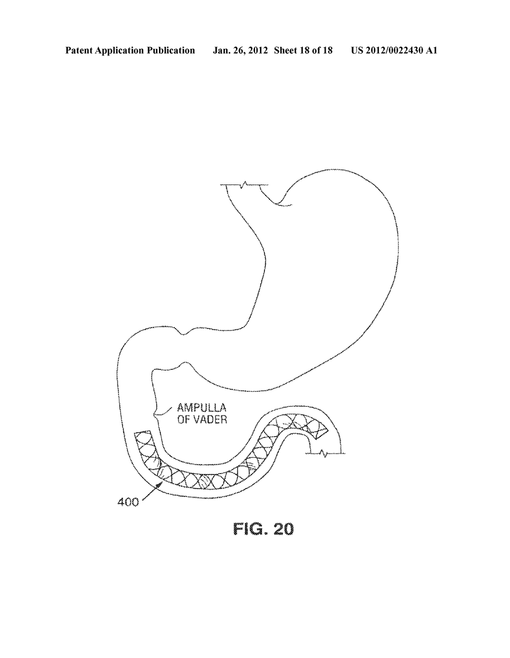 SATIATION DEVICES AND METHODS - diagram, schematic, and image 19