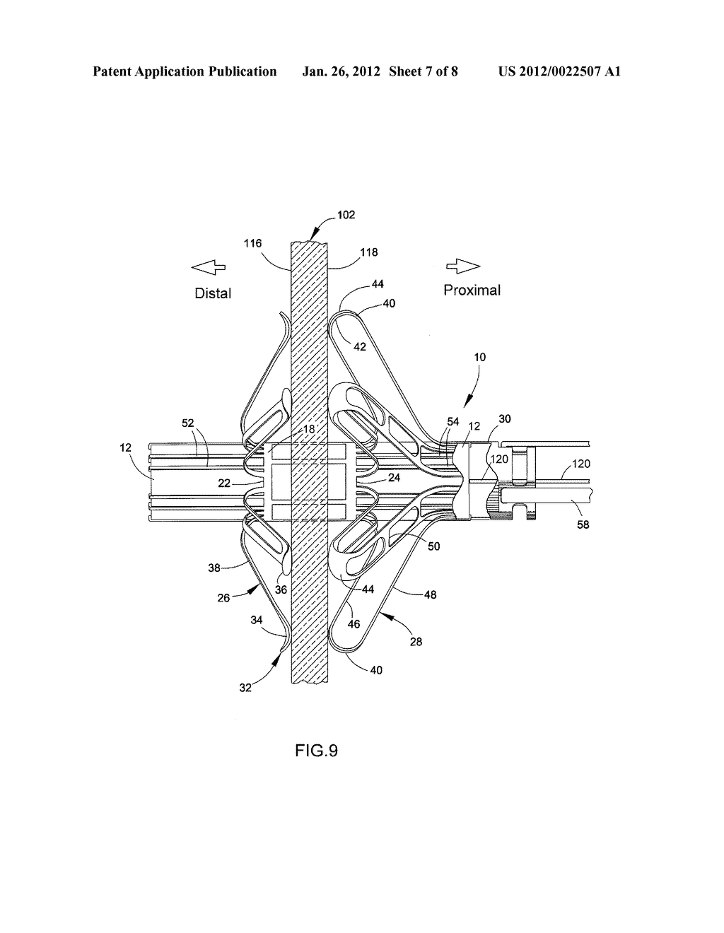 DELIVERY SYSTEM, METHOD, AND ANCHOR FOR MEDICAL IMPLANT PLACEMENT - diagram, schematic, and image 08