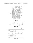 METHODS FOR IMPROVED STENT RETENTION diagram and image