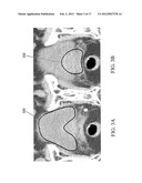 METHODS, SYSTEMS, AND COMPUTER READABLE MEDIA FOR MAPPING REGIONS IN A     MODEL OF AN OBJECT COMPRISING AN ANATOMICAL STRUCTURE FROM ONE IMAGE DATA     SET TO IMAGES USED IN A DIAGNOSTIC OR THERAPEUTIC INTERVENTION diagram and image