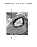 METHODS, SYSTEMS, AND COMPUTER READABLE MEDIA FOR MAPPING REGIONS IN A     MODEL OF AN OBJECT COMPRISING AN ANATOMICAL STRUCTURE FROM ONE IMAGE DATA     SET TO IMAGES USED IN A DIAGNOSTIC OR THERAPEUTIC INTERVENTION diagram and image